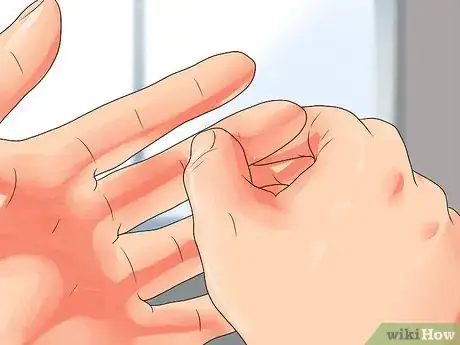 Imagen titulada Determine if a Finger Is Broken Step 5