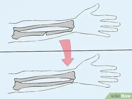Imagen titulada Manage a Broken Arm Step 20