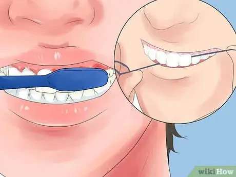 Imagen titulada Alleviate Orthodontic Brace Pain Step 15