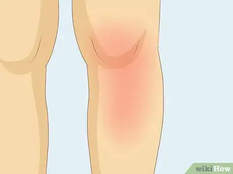 Imagen titulada Know If You Have Worms Step 14