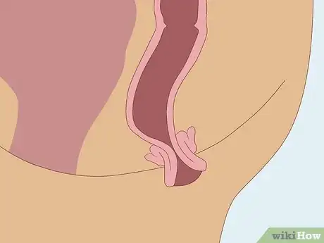 Imagen titulada Know If You Have Worms Step 24