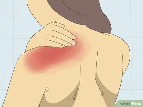 Imagen titulada Heal a Pulled Trapezius Muscle Step 4