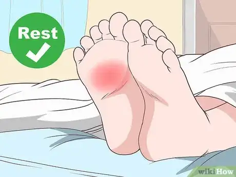 Imagen titulada Cure Metatarsalgia Step 1