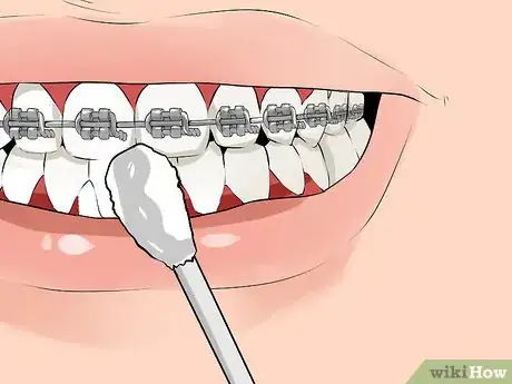 Imagen titulada Fix a Broken Braces Wire Step 2