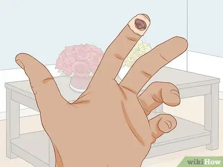 Imagen titulada Treat a Blood Blister Step 5