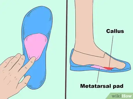 Imagen titulada Cure Metatarsalgia Step 7