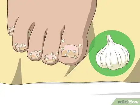 Imagen titulada Treat Toe Nail Fungus Step 5