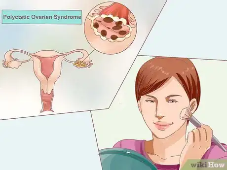 Imagen titulada Balance Hormones for Acne Step 9