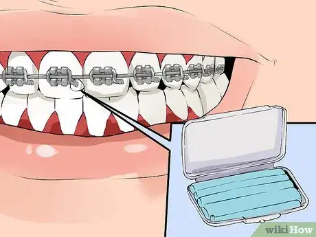 Imagen titulada Fix a Broken Braces Wire Step 4