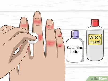 Imagen titulada Get Rid of Chilblains Step 1