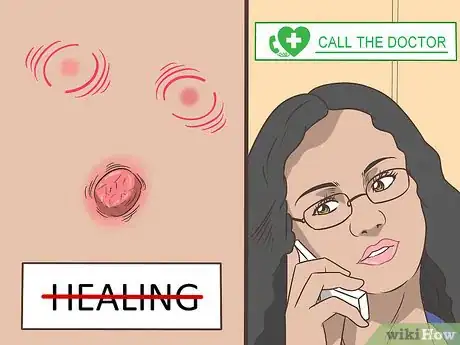 Imagen titulada Recognize Melanoma Step 12