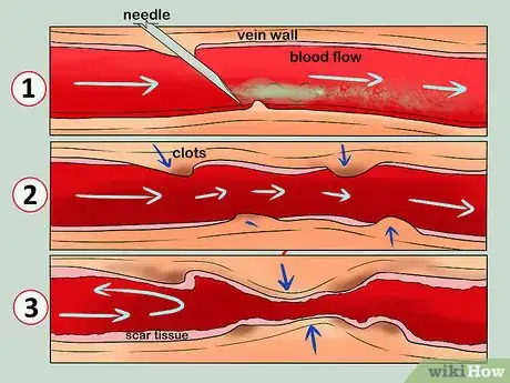 Imagen titulada Know when Your Vein Has Collapsed Step 4