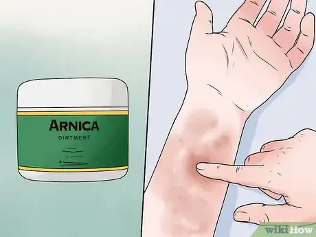 Imagen titulada Reduce Bruising Step 3