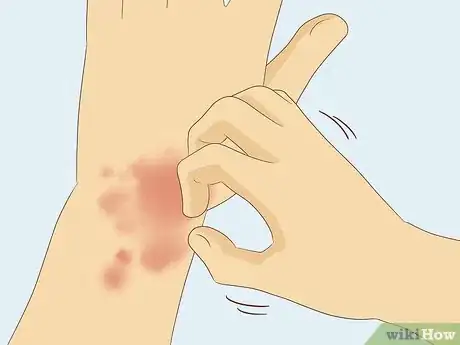 Imagen titulada Know If You Have Worms Step 12