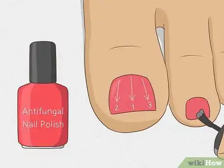 Imagen titulada Hide Nail Fungus Step 4