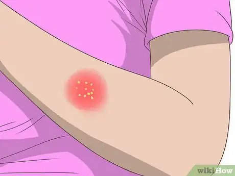 Imagen titulada Recognize Boils Step 4