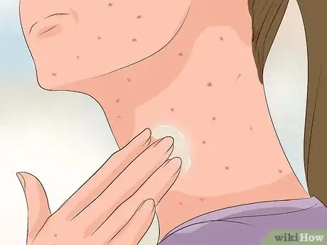 Imagen titulada Recognize Chickenpox Step 13