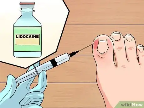 Imagen titulada Cure an Infected Toe Step 5