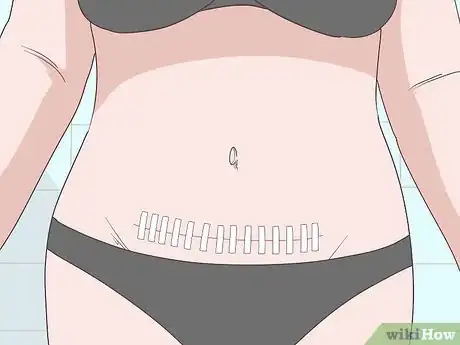 Imagen titulada Reduce Swelling After Liposuction Step 2