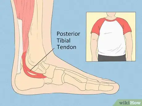 Imagen titulada Fix Flat Feet Step 4