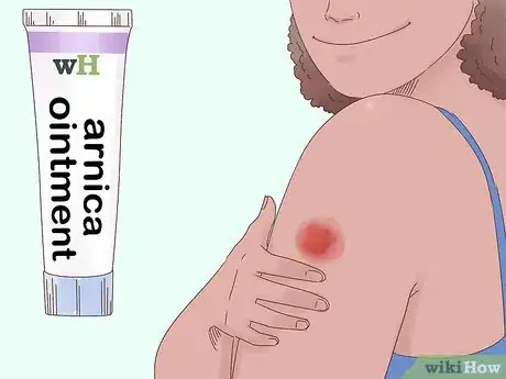 Imagen titulada Get Rid of Bruises Step 11