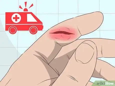 Imagen titulada Treat a Cut Finger Step 10