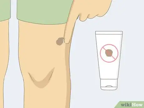 Imagen titulada Remove Moles Quickly Step 17