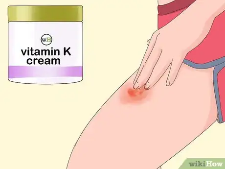 Imagen titulada Get Rid of Bruises Step 13