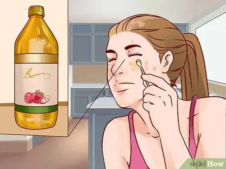 Imagen titulada Get Rid of a Deep Pimple Step 12
