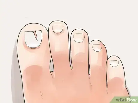 Imagen titulada Treat a Stubbed Toe Step 11