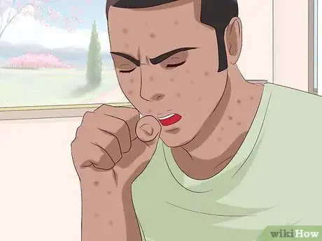 Imagen titulada Recognize Chickenpox Step 19