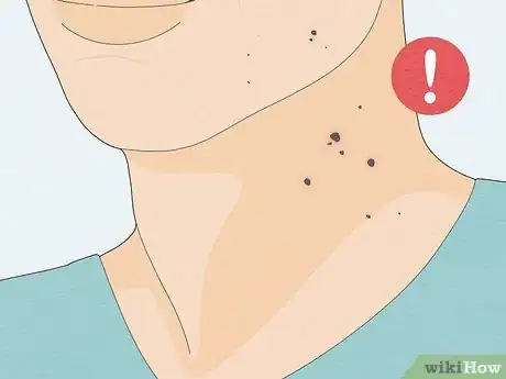Imagen titulada Remove a Mole with Iodine Step 13