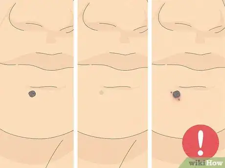 Imagen titulada Remove a Mole with Iodine Step 15