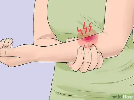 Imagen titulada Know when Your Vein Has Collapsed Step 2
