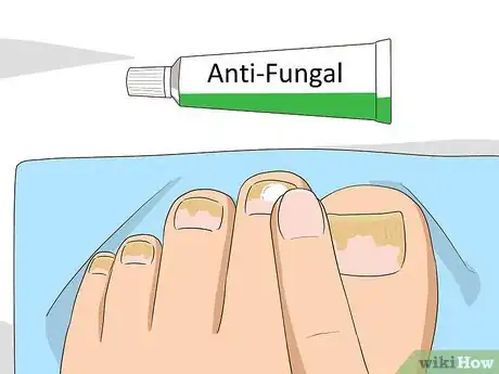 Imagen titulada Treat Toe Nail Fungus Step 3