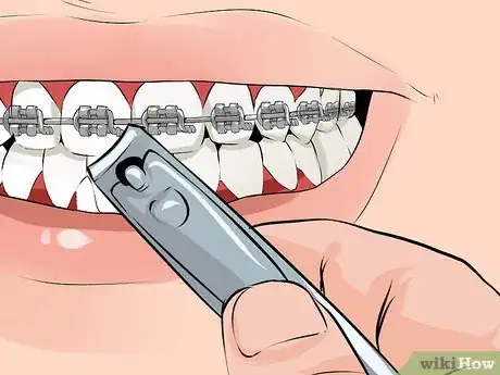 Imagen titulada Fix a Broken Braces Wire Step 3