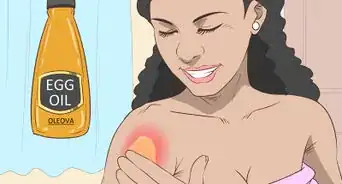 tratar una quemadura de sol