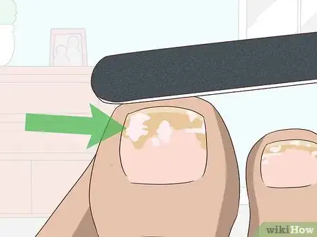 Imagen titulada Treat Toe Nail Fungus Step 2
