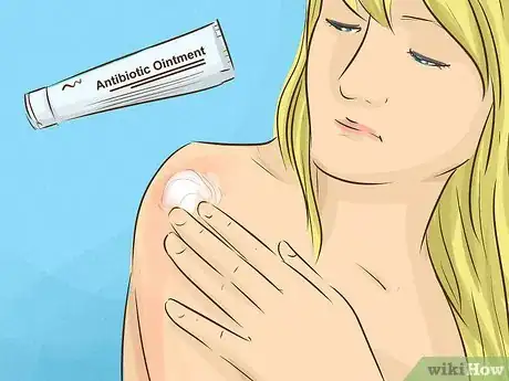 Imagen titulada Treat a Sunburn Step 18