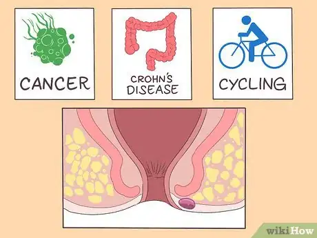 Imagen titulada Prevent Perianal Abscess from Returning Step 13