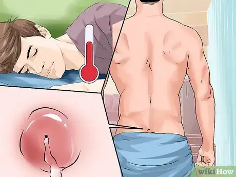 Imagen titulada Treat a Pilonidal Cyst Step 12