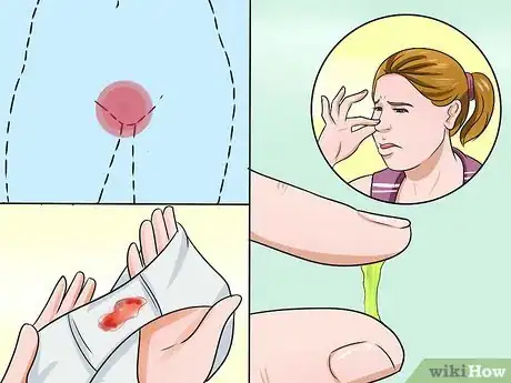 Imagen titulada Stop Vaginal Itching Step 13