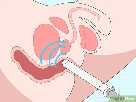 Imagen titulada Prevent Perianal Abscess from Returning Step 15
