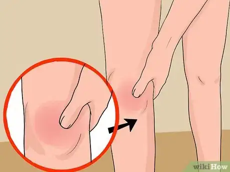 Imagen titulada Treat a Swollen Knee Step 1
