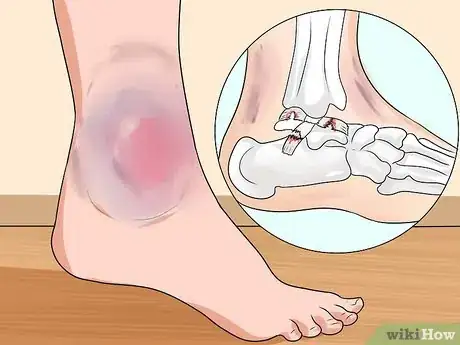 Imagen titulada Know if You've Sprained Your Ankle Step 8