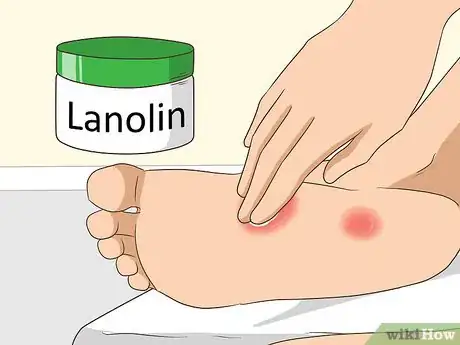 Imagen titulada Get Rid of Chilblains Step 2