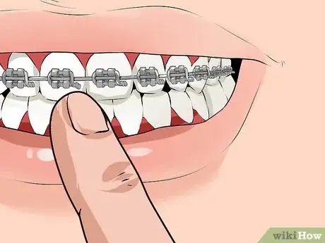 Imagen titulada Fix a Broken Braces Wire Step 1