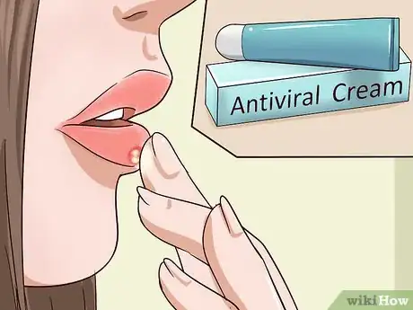 Imagen titulada Get Rid of a Cold Sore Fast Step 1