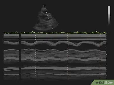 Imagen titulada Interpret Echocardiograms Step 8