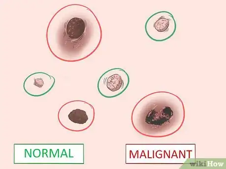 Imagen titulada Recognize Melanoma Step 9